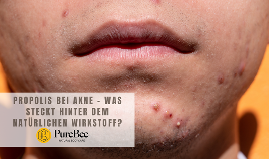 Propolis bei Akne – was steckt hinter dem natürlichen Wirkstoff?